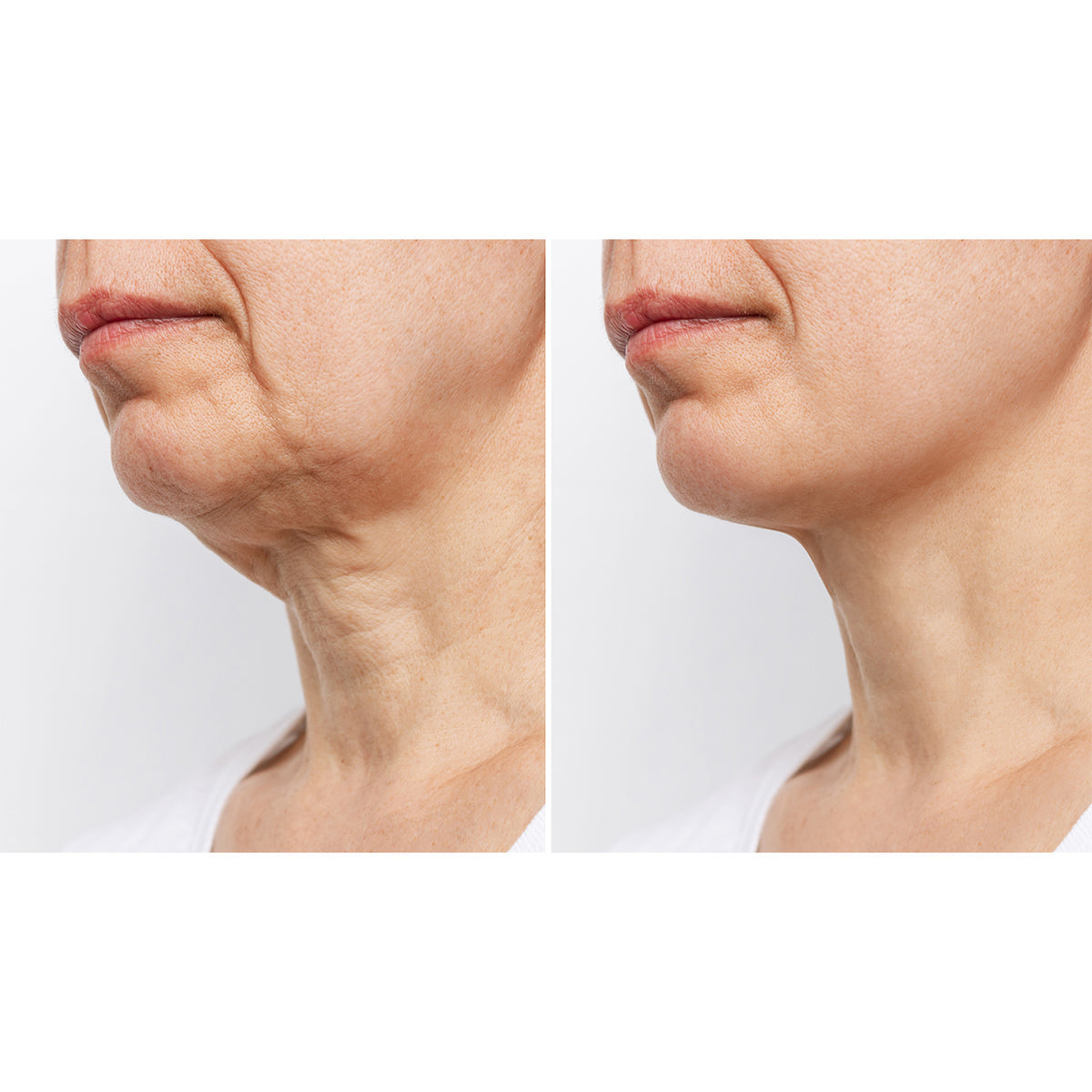 Wrinkle Reducing Neck Therapy Device