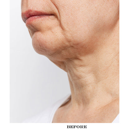 Wrinkle Reducing Neck Therapy Device