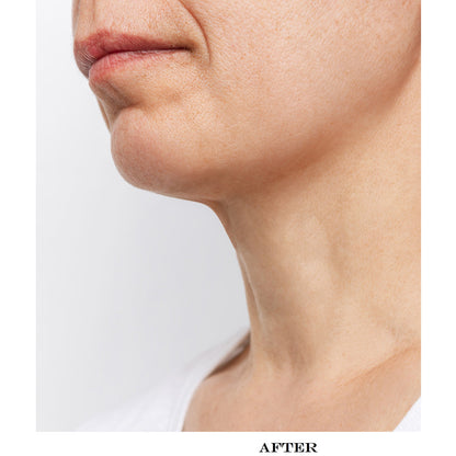 Wrinkle Reducing Neck Therapy Device