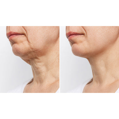 Wrinkle Reducing Neck Therapy Device