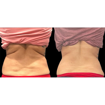 5-in-1 Body Contouring Device